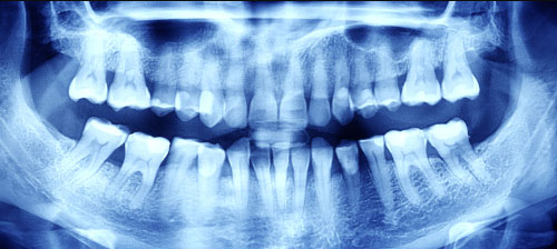 Dental X-Ray