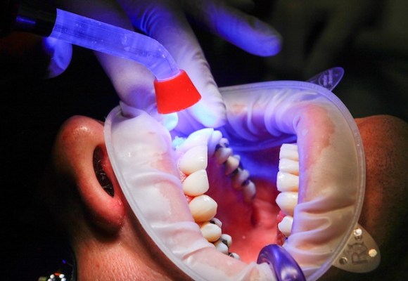 Dental Fillings & Restorations